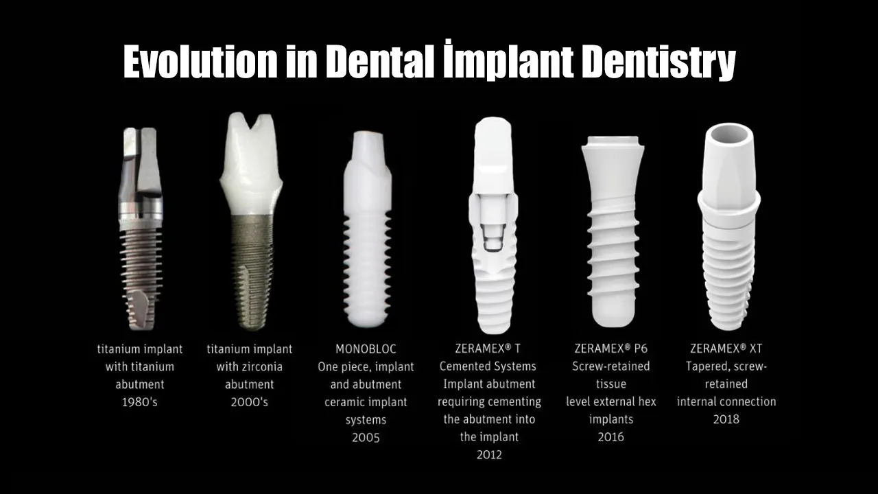 History of Dental Implant