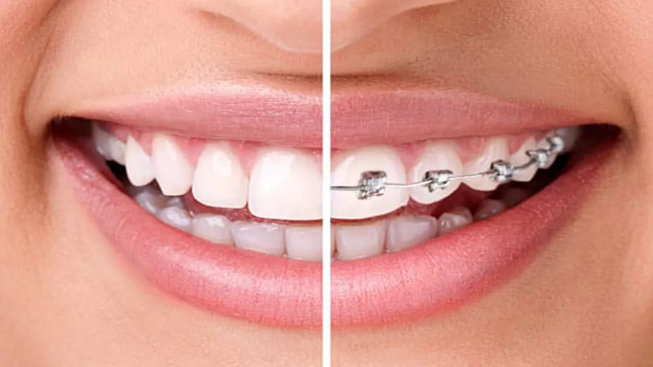 Orthodontics Definition