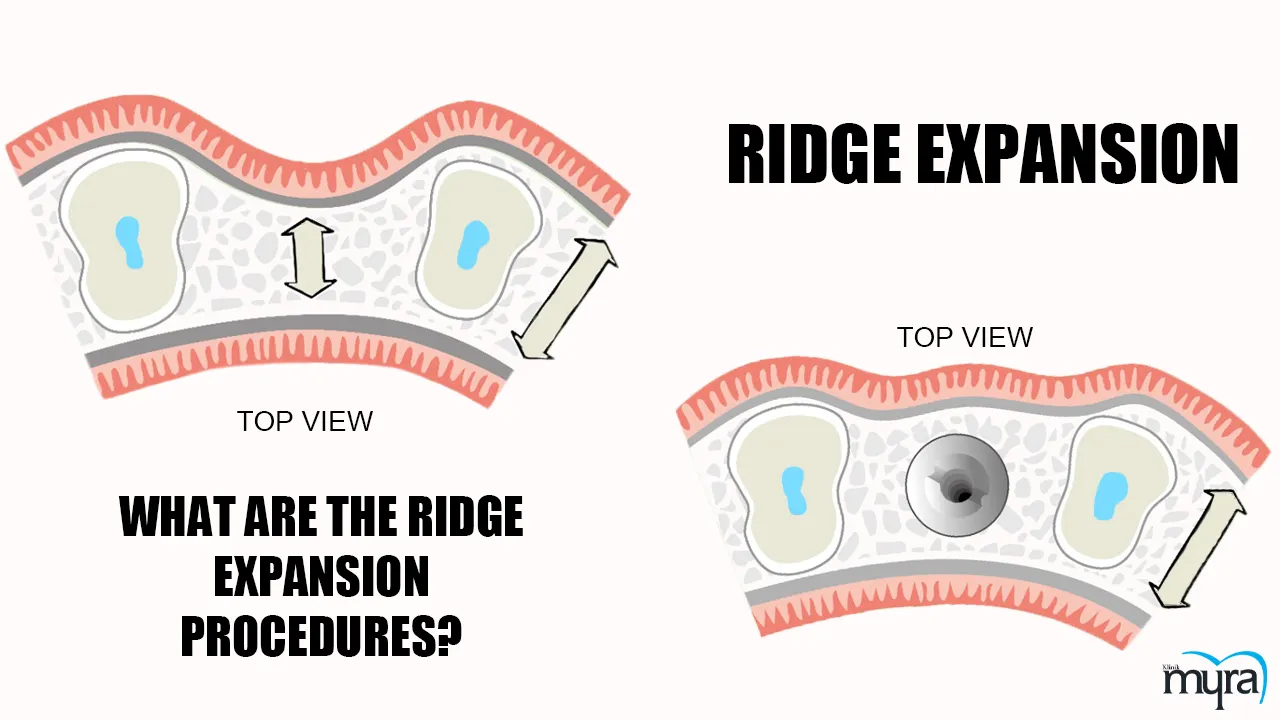 Ridge Expansion Definition