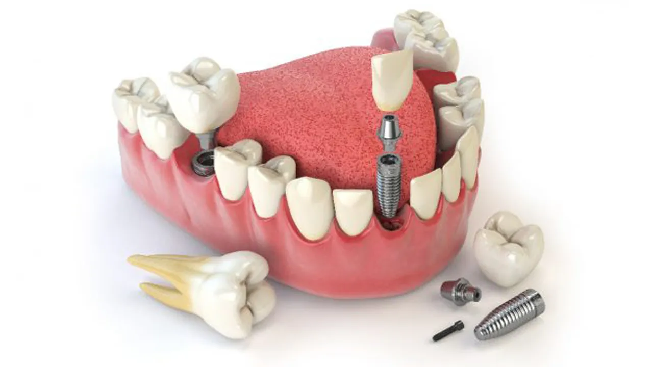 Factors that Affect Success Of Dental Implant