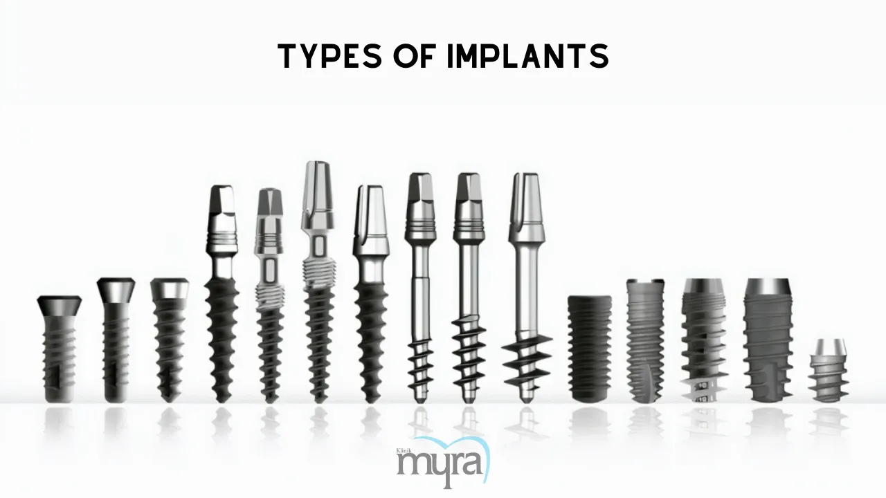 Pricing details for dental implants in the UK