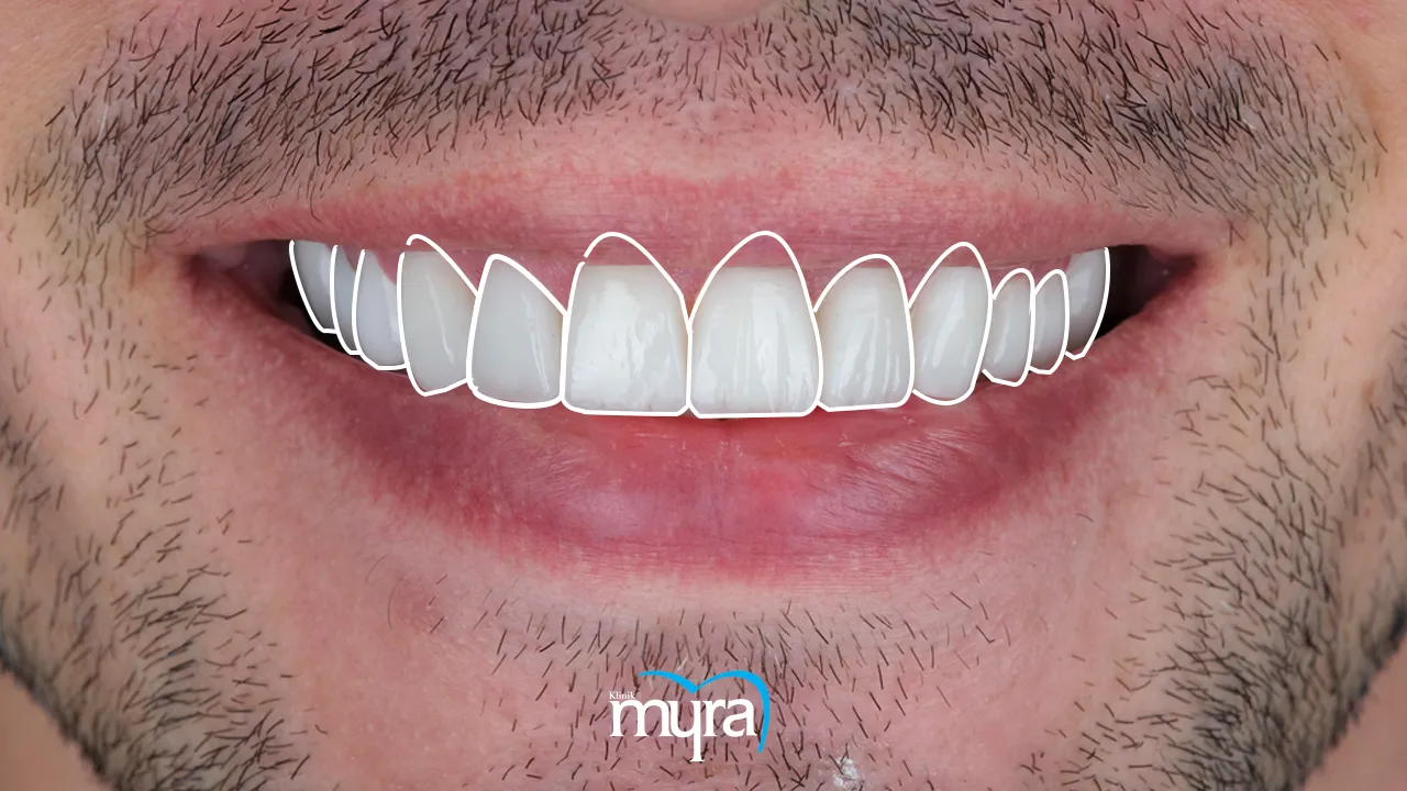 Typical number of veneers required for dental restoration