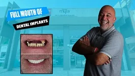 Full-mouth-reconstruction-all-on-six-implants-with-zirconium-crowns