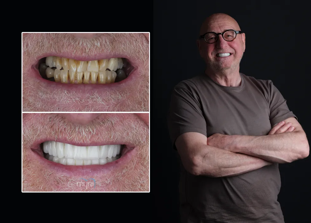 What is Emax Dental Crown?