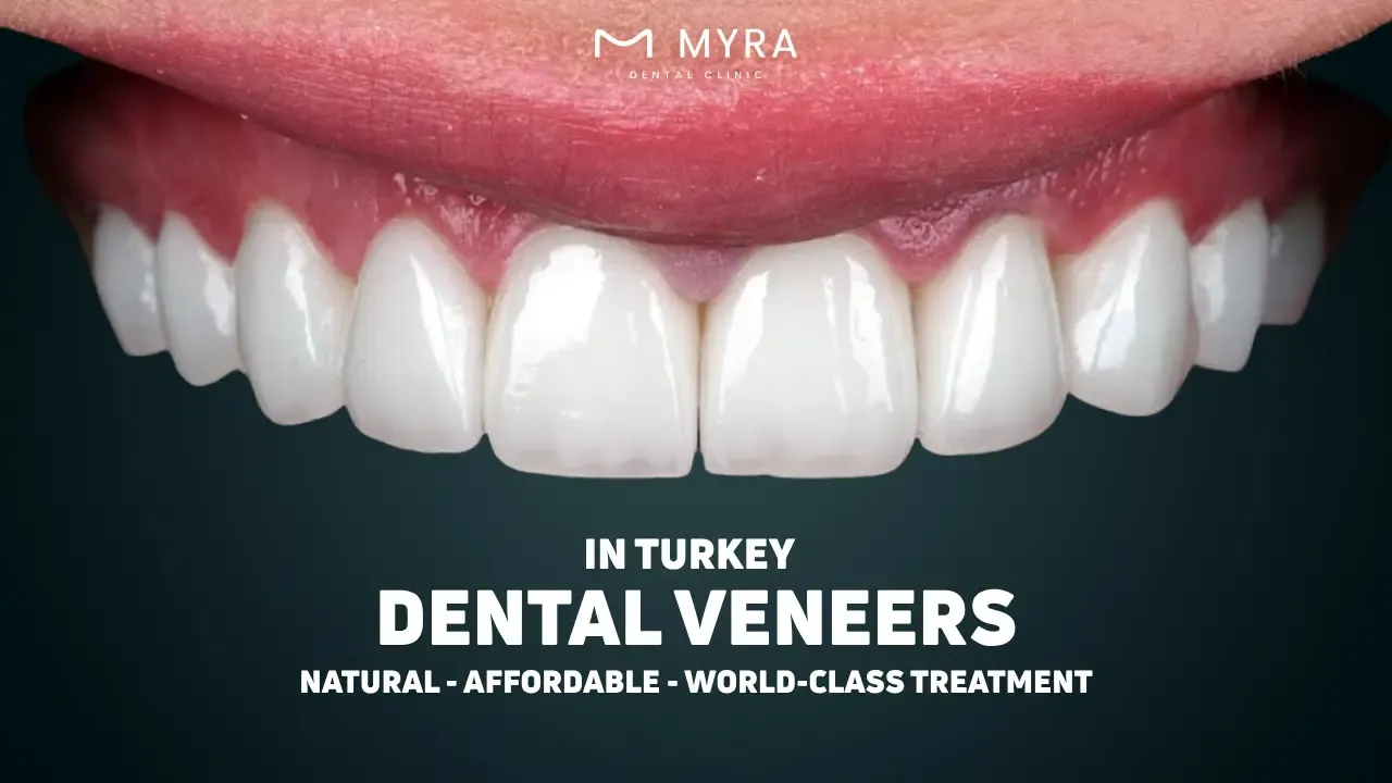 Dental Veneers in Turkey Antalya Prices Pros Cons