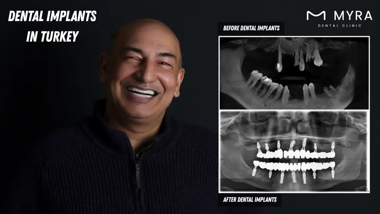 dental implants in turkey