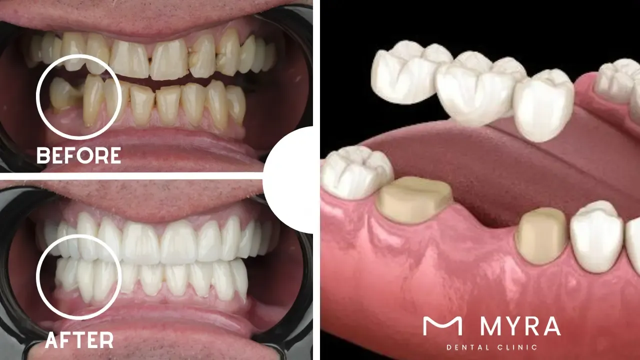 Dental.Bridge.vs.Implant.key.Differences.and.Factors.in.Choosing.in.turkey.webp