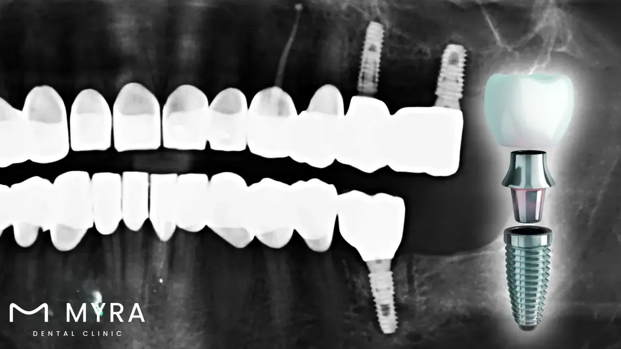 Titanium.Implants.Cost.Benefits.and.Risks.in.turkey.webp