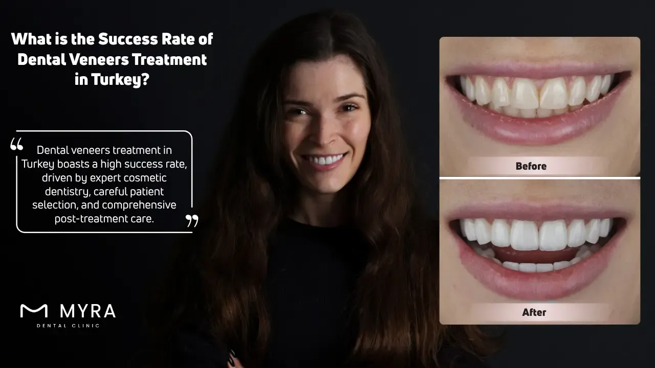 What is the Success Rate of Dental Veneers Treatment in Turkey
