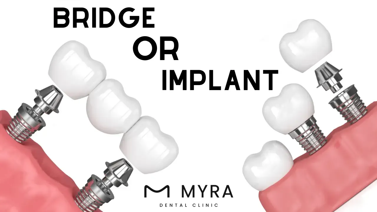 What.are.the.Factors.in.Choosing.between.Dental.Bridges.and.Implants.in.turkey.webp