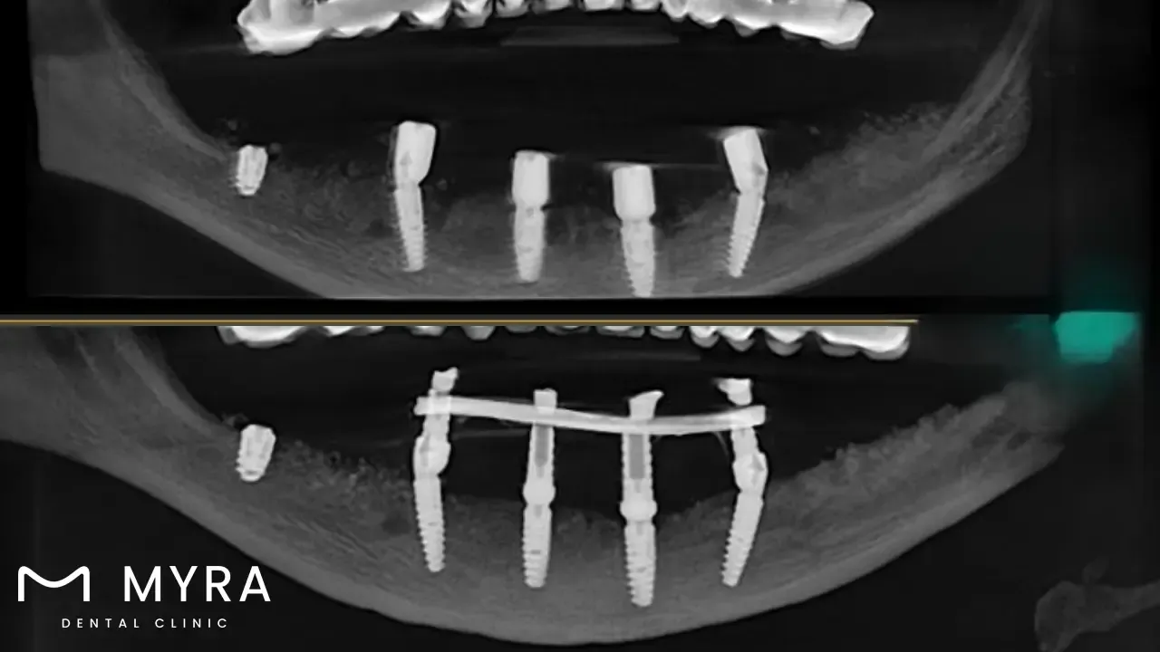 What.are.the.Risks.associated.with.Titanium.implants.in.turkey.webp