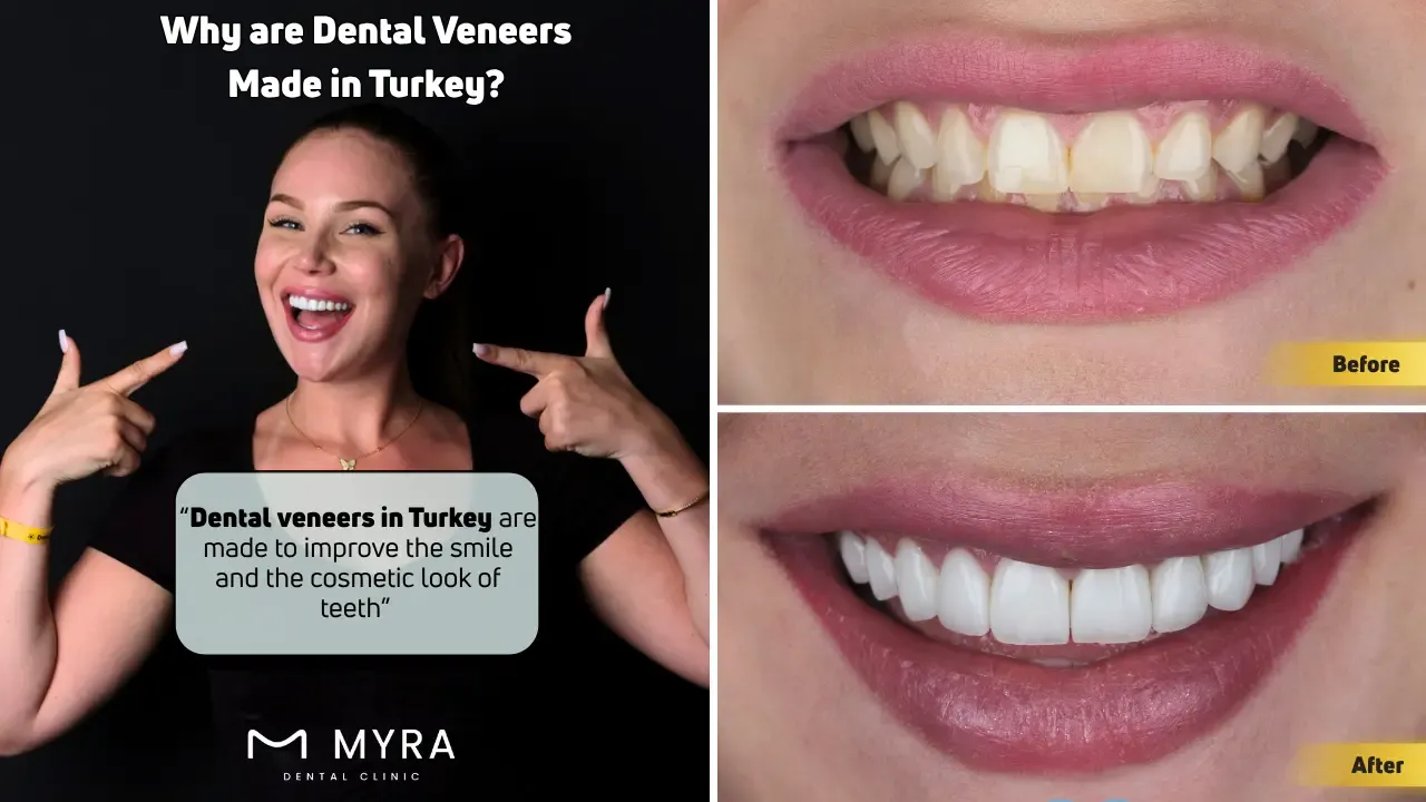 Why are Dental Veneers Made in Turkey.