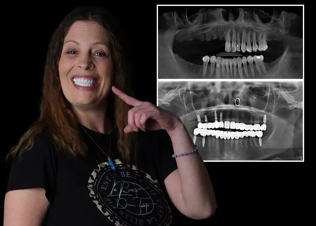 Cosmetic dentures in turkey