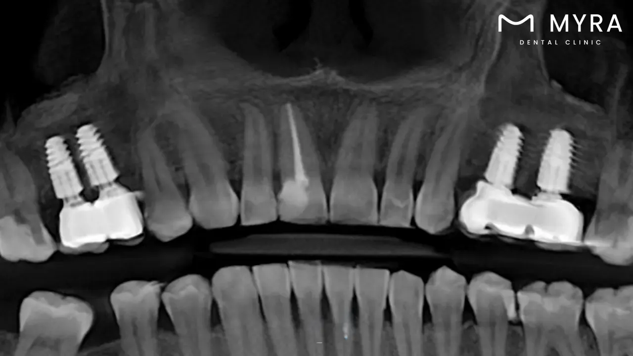dental implants