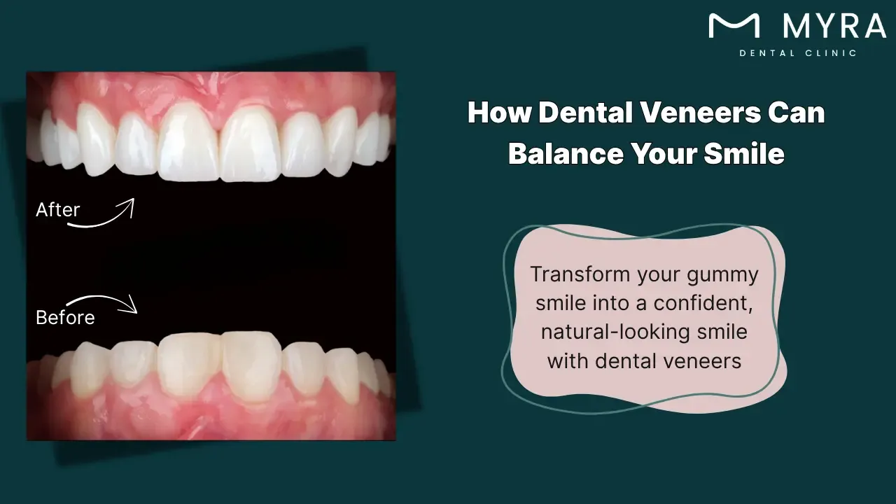 Dental veneers