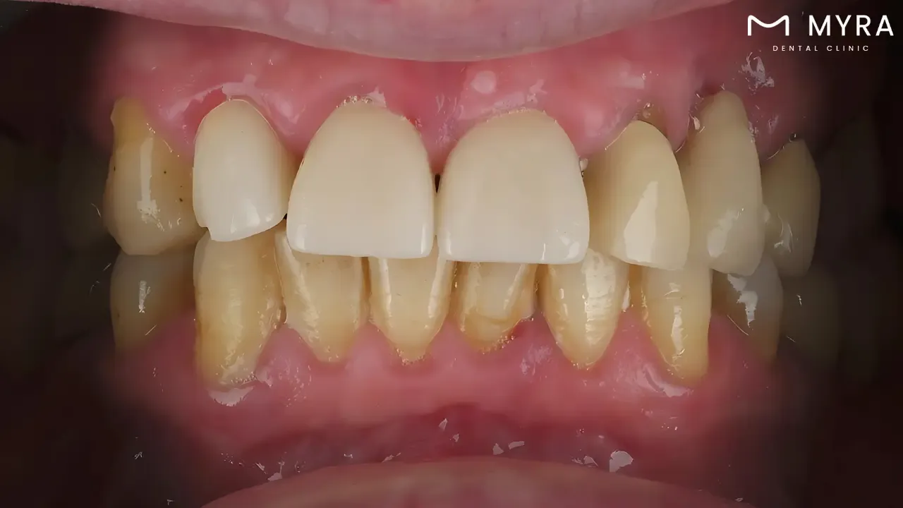 Tooth stains vs. cavities: Distinguishing between them