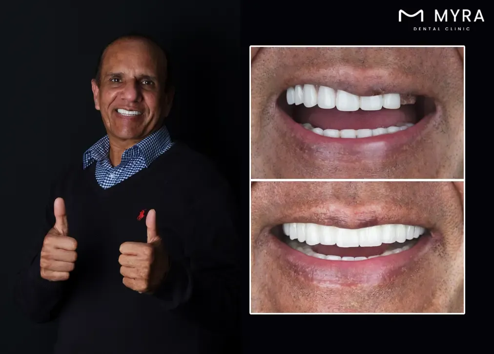 Emax crown turkey antalya