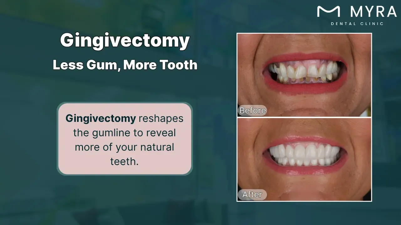 Gingivectomy