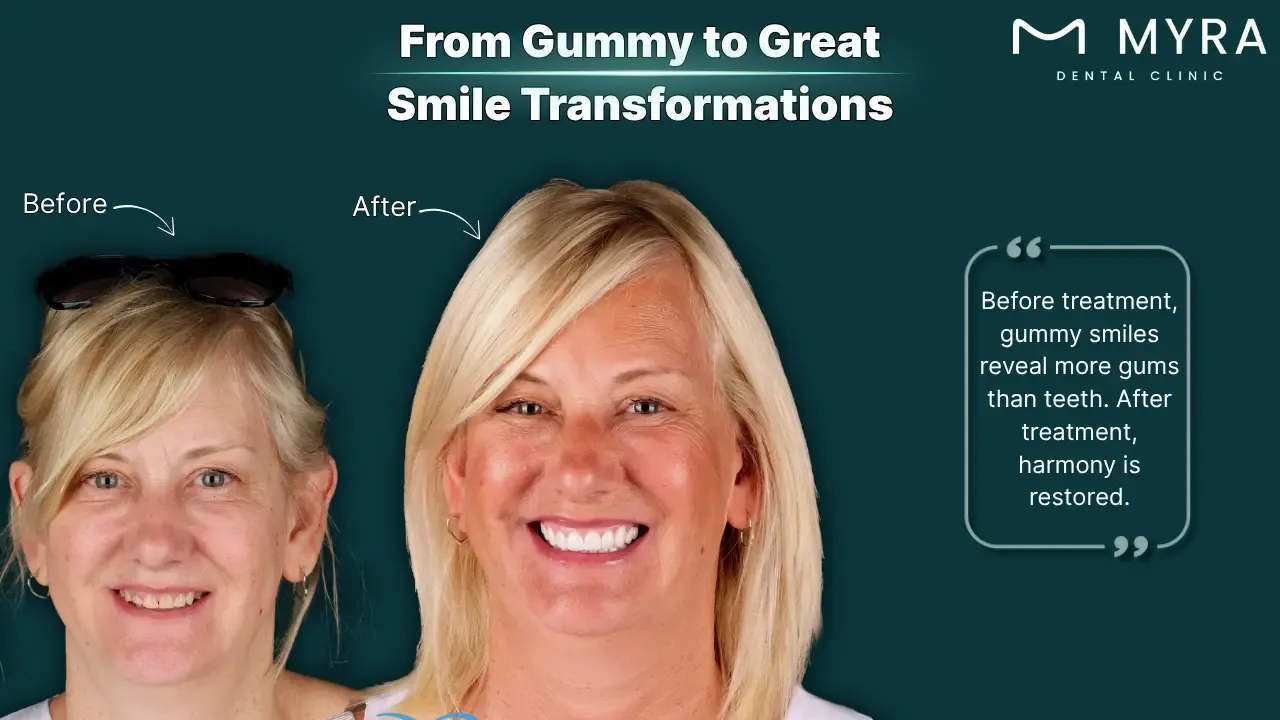 Gummy smile before and after treatment