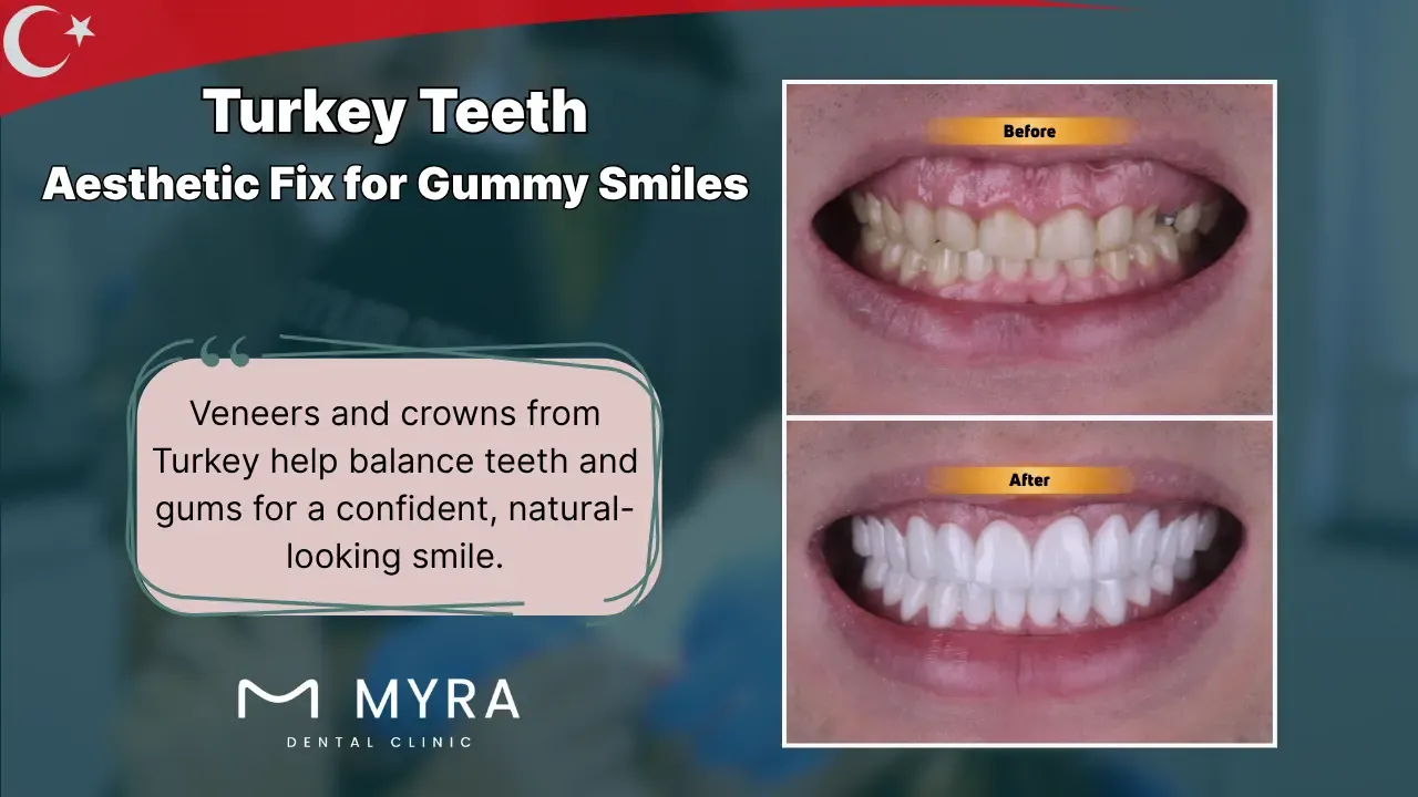 How can a "turkey teeth" makeover fix a gummy smile?