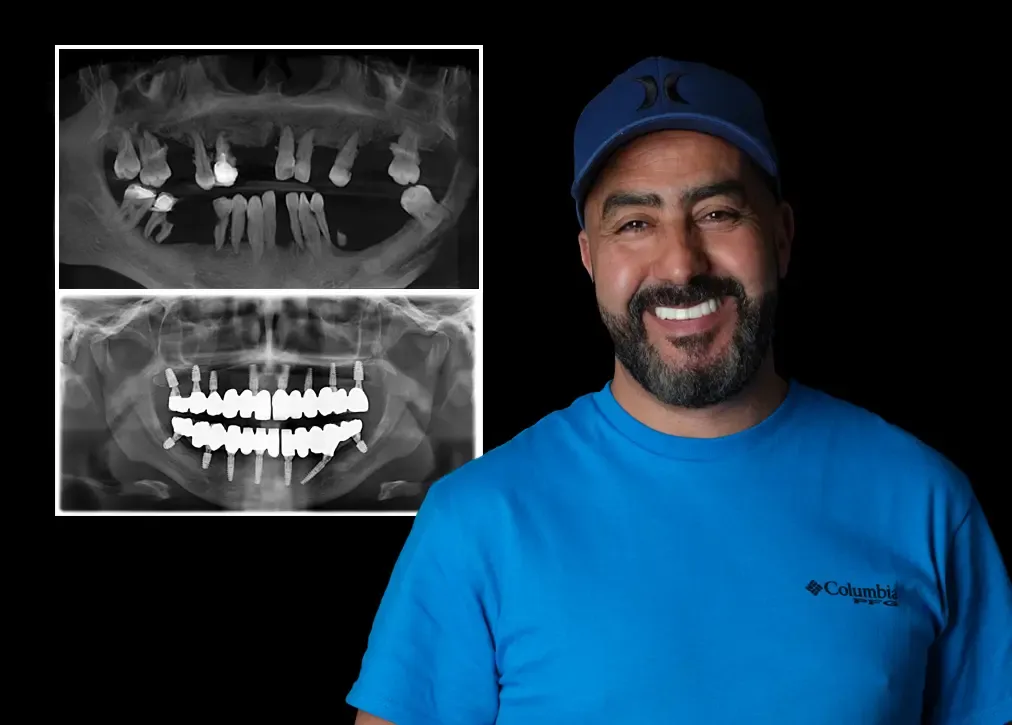 How is cosmetic denture treatment in turkey done?
