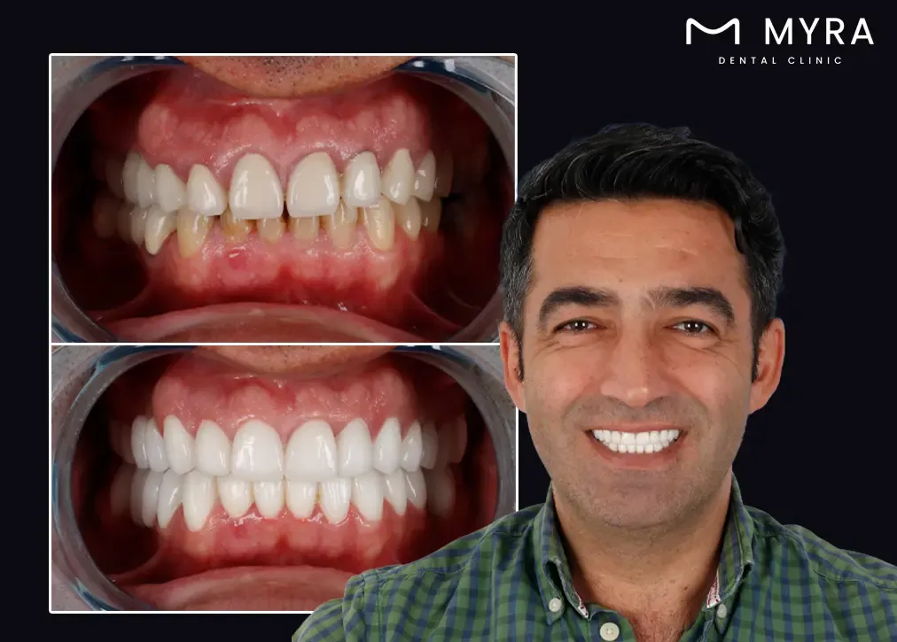 How is gum contouring in turkey treatment done?