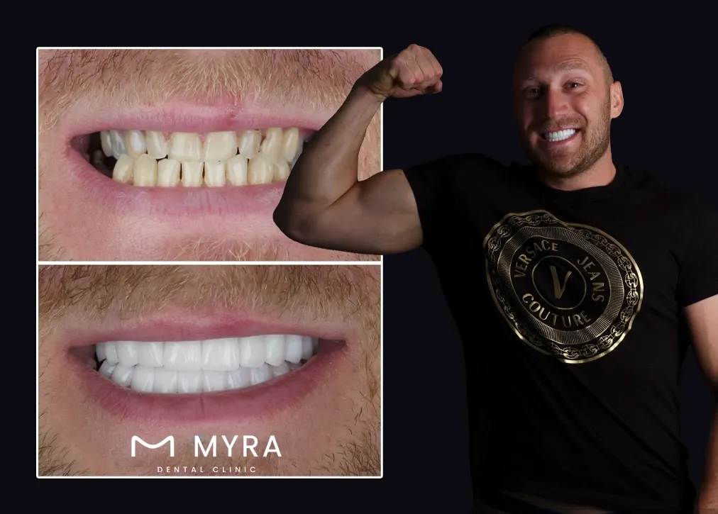 How is a gum shield in turkey treatment done?