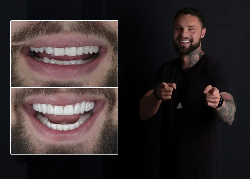 How much is the average cost of dental lumineers in turkey?