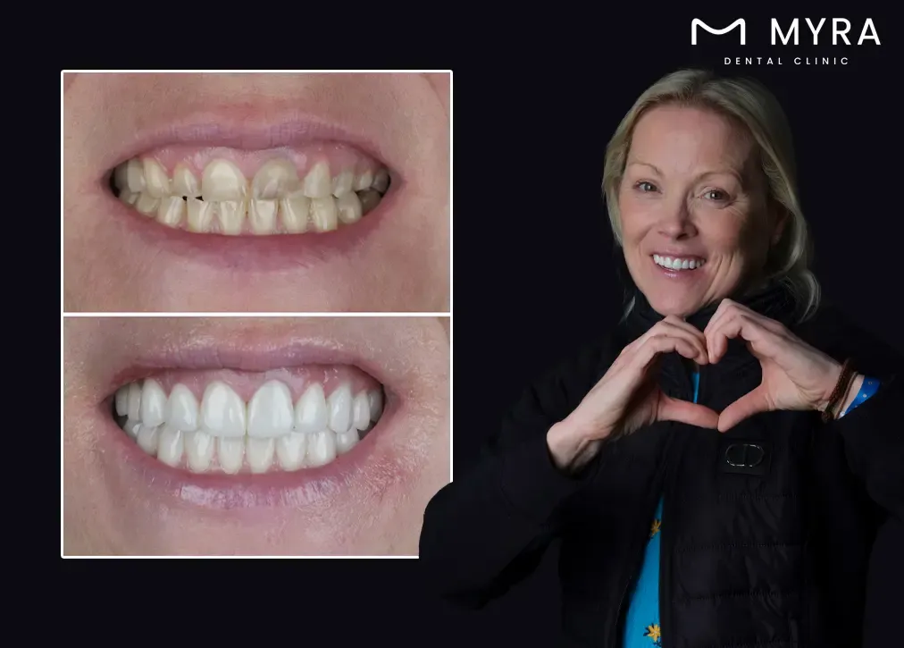 How to explain the concept of gum contouring in turkey