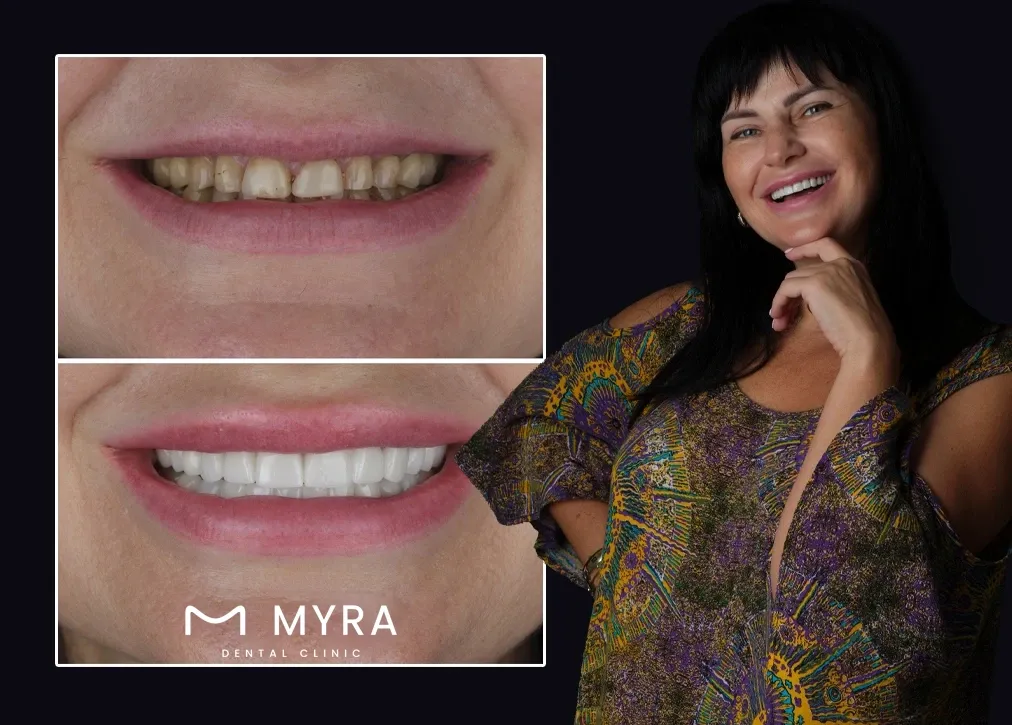 How to explain the concept of a gum shield in turkey