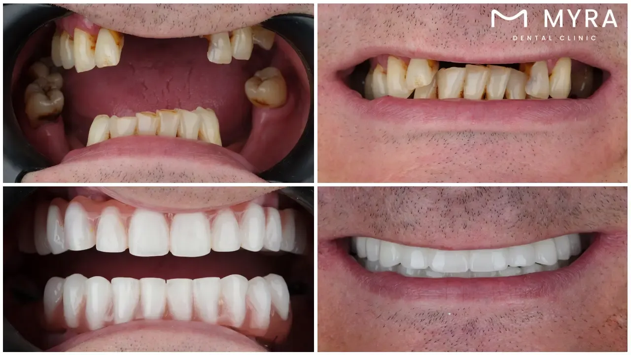 immediate dentures