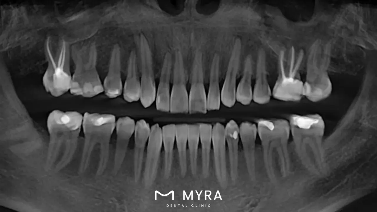 root canal therapy