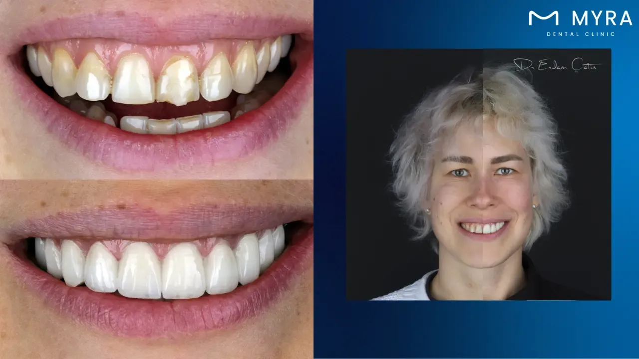 stained-teeth-causes-symptoms-treatment.webp