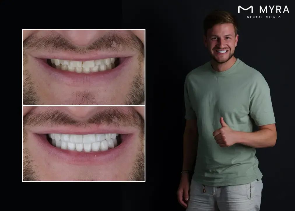 What are the advantages of emax dental crown