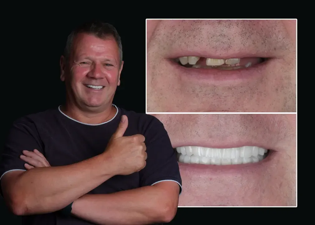 What are the benefits of a root canal treatment in turkey?