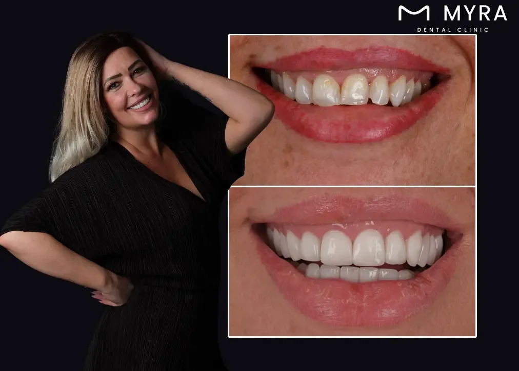 What are the benefits of gum contouring in turkey?