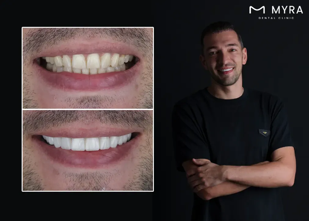 What are the colour options for an emax dental crown