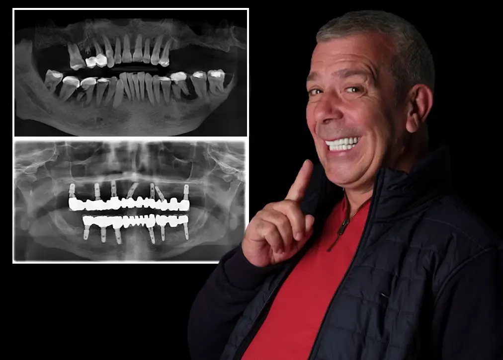 what-are-the-cosmetic-denture-materials.webp