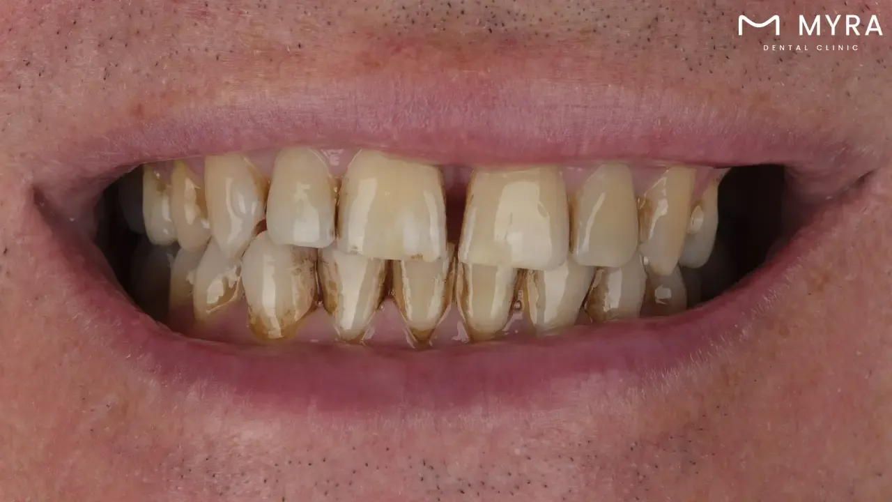 What are the differences between stained teeth and cavities?