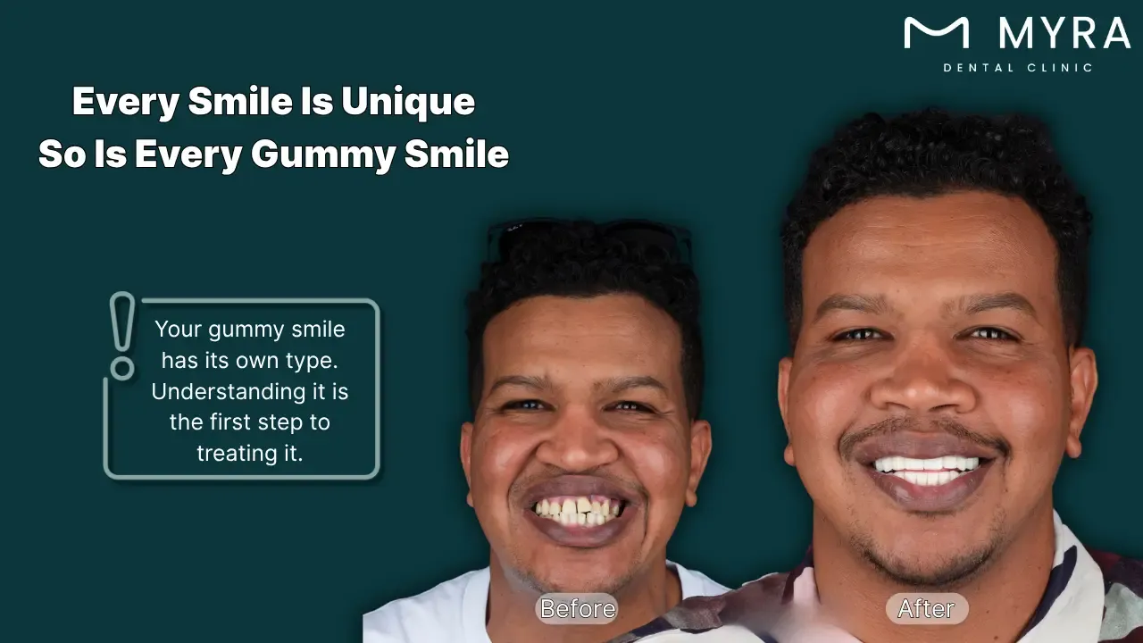 What are the different types of gummy smiles?