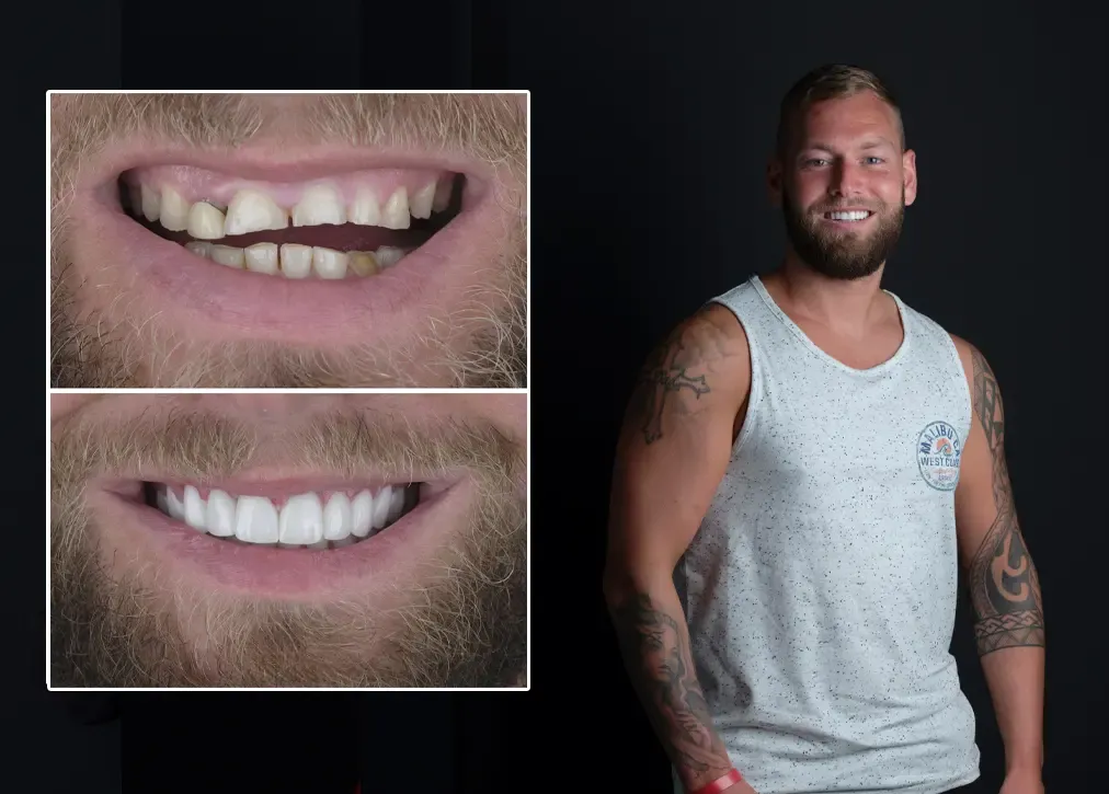 What are the factors affecting the cost of dental lumineers in turkey?