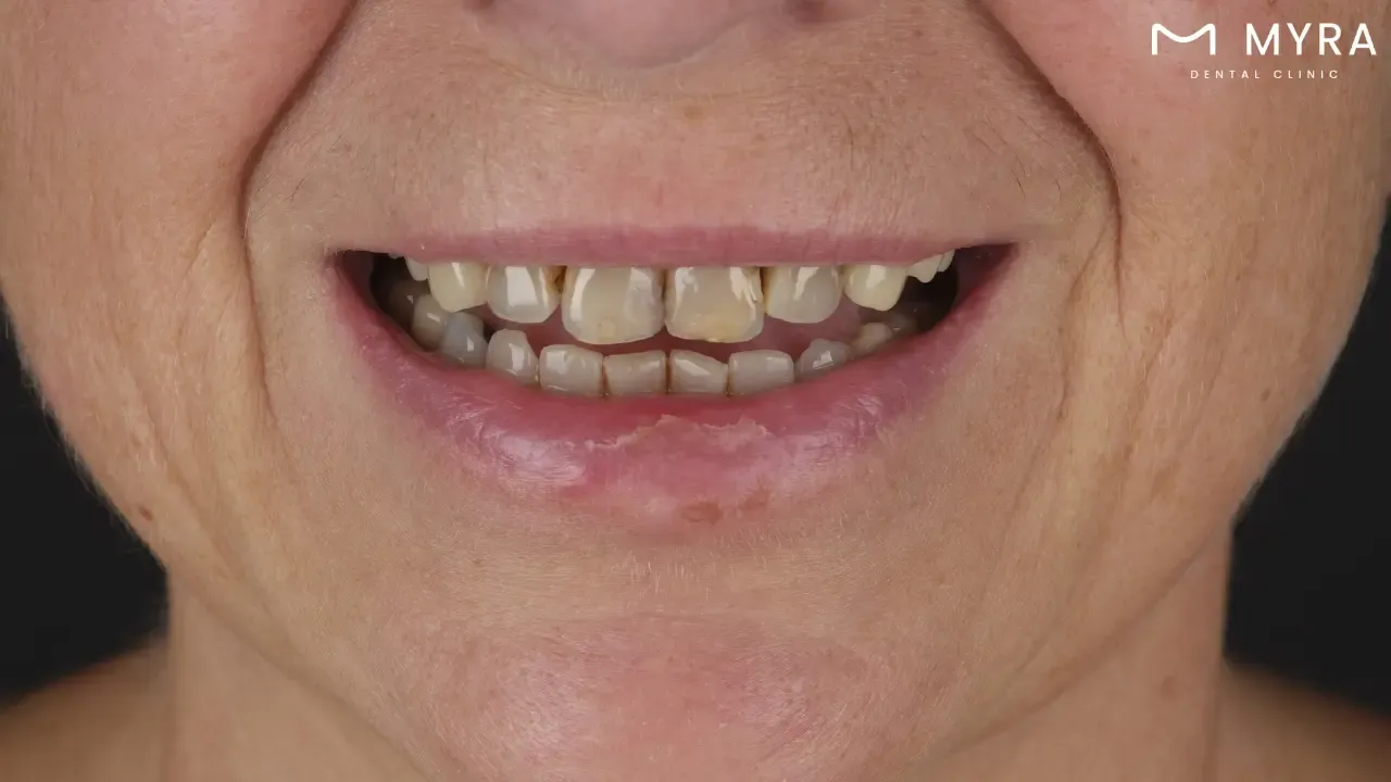 What are the symptoms of stained teeth?