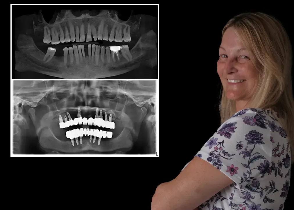 what-are-the-types-of-cosmetic-dentures.webp