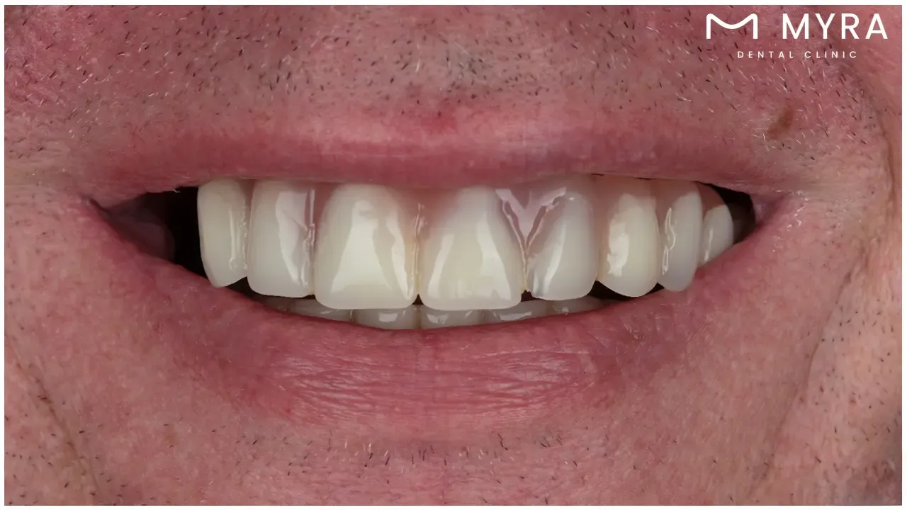 what is a denture?