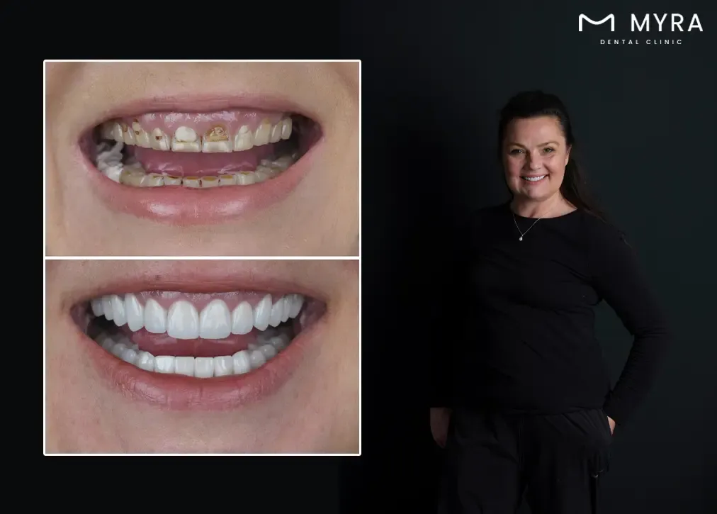 Who is emax dental crown recommended for