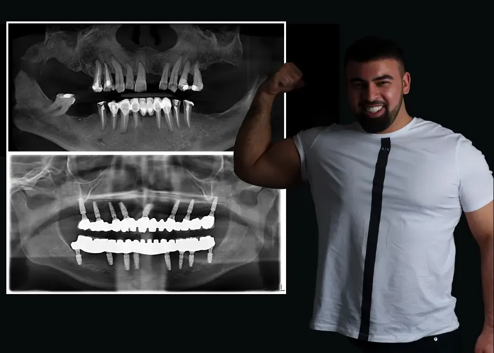 Why are cosmetic dentures important in turkey?