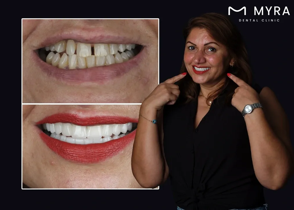 Why are gum shields important in turkey?