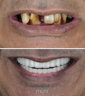 Teeth Turkey Pictures for an all on 4 implants case and get full mouth rehabilitation.