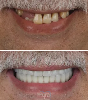 Teeth Turkey Pictures for an all on 6 case rehabilitaion with implants.