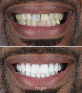 Teeth Turkey Pictures has done with a smile makeover and he got 28 Zirconium Crowns and 6 teeth Implants for missing teeth.